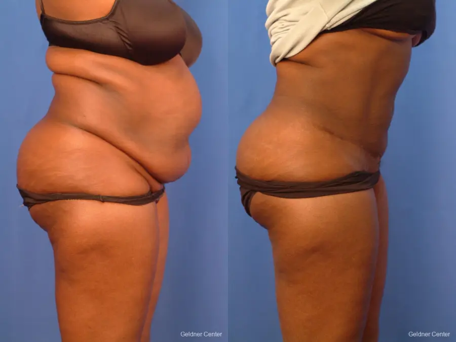 Liposuction: Patient 19 - Before and After 2