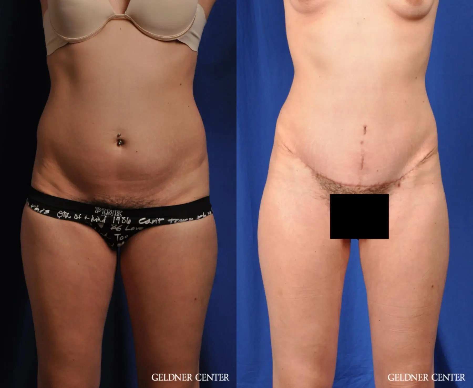 Liposuction: Patient 41 - Before and After  