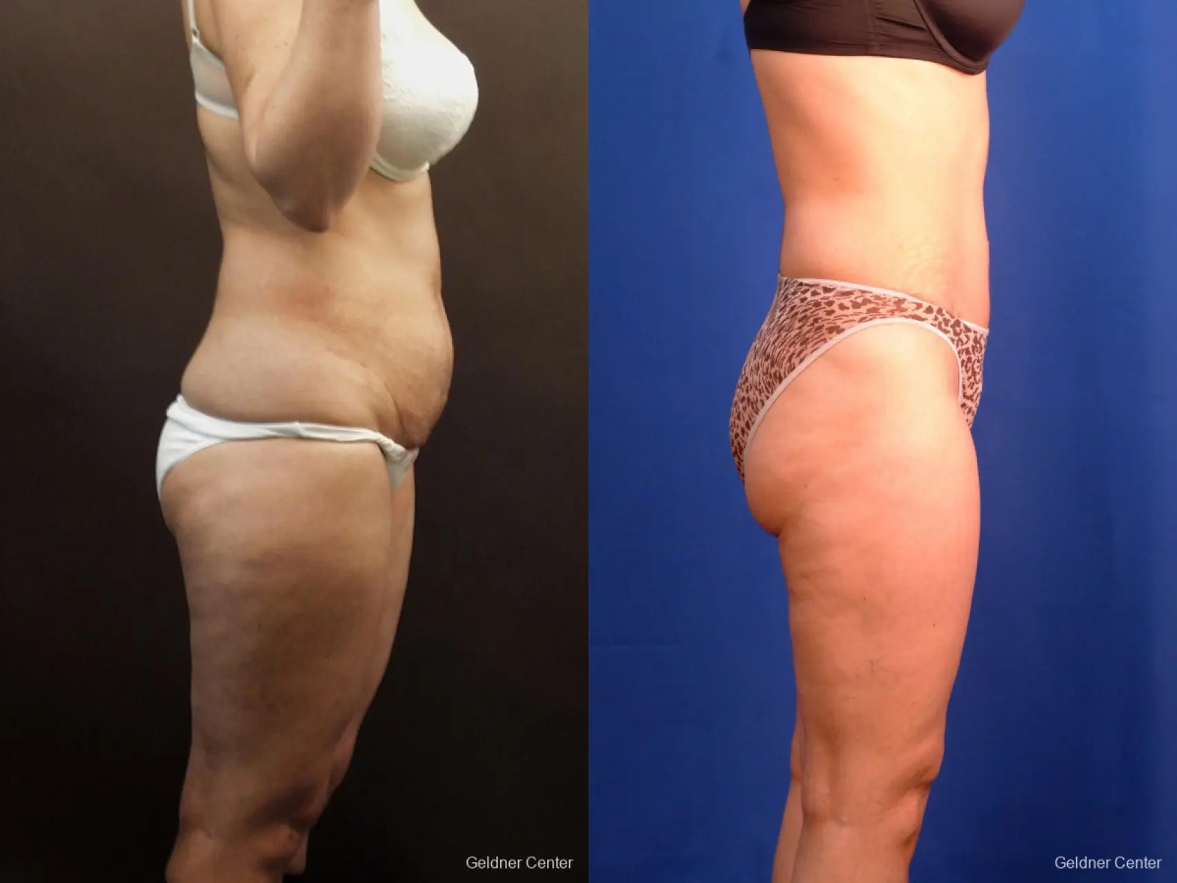 Liposuction: Patient 9 - Before and After 3