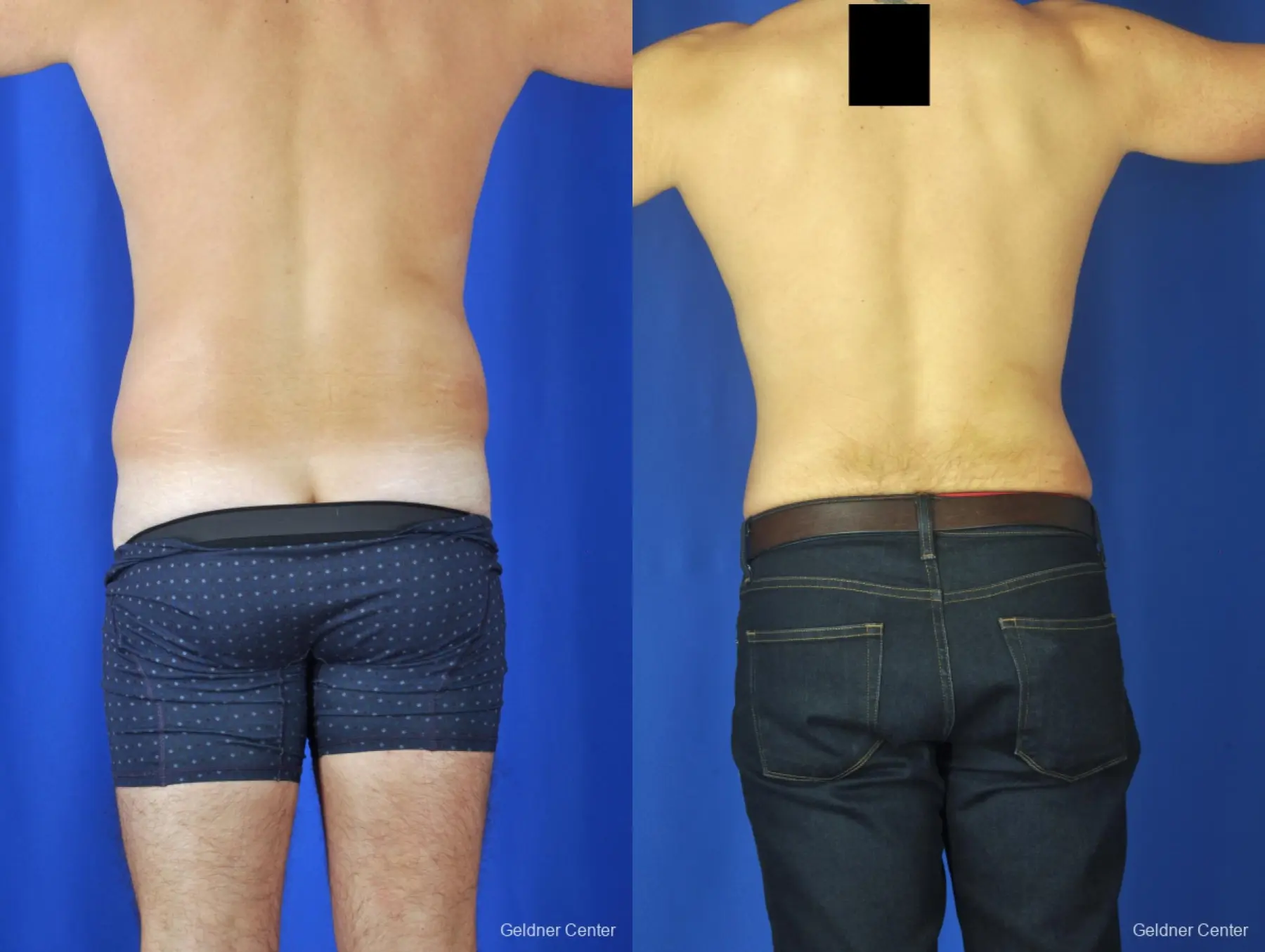Liposuction For Men: Patient 4 - Before and After 4