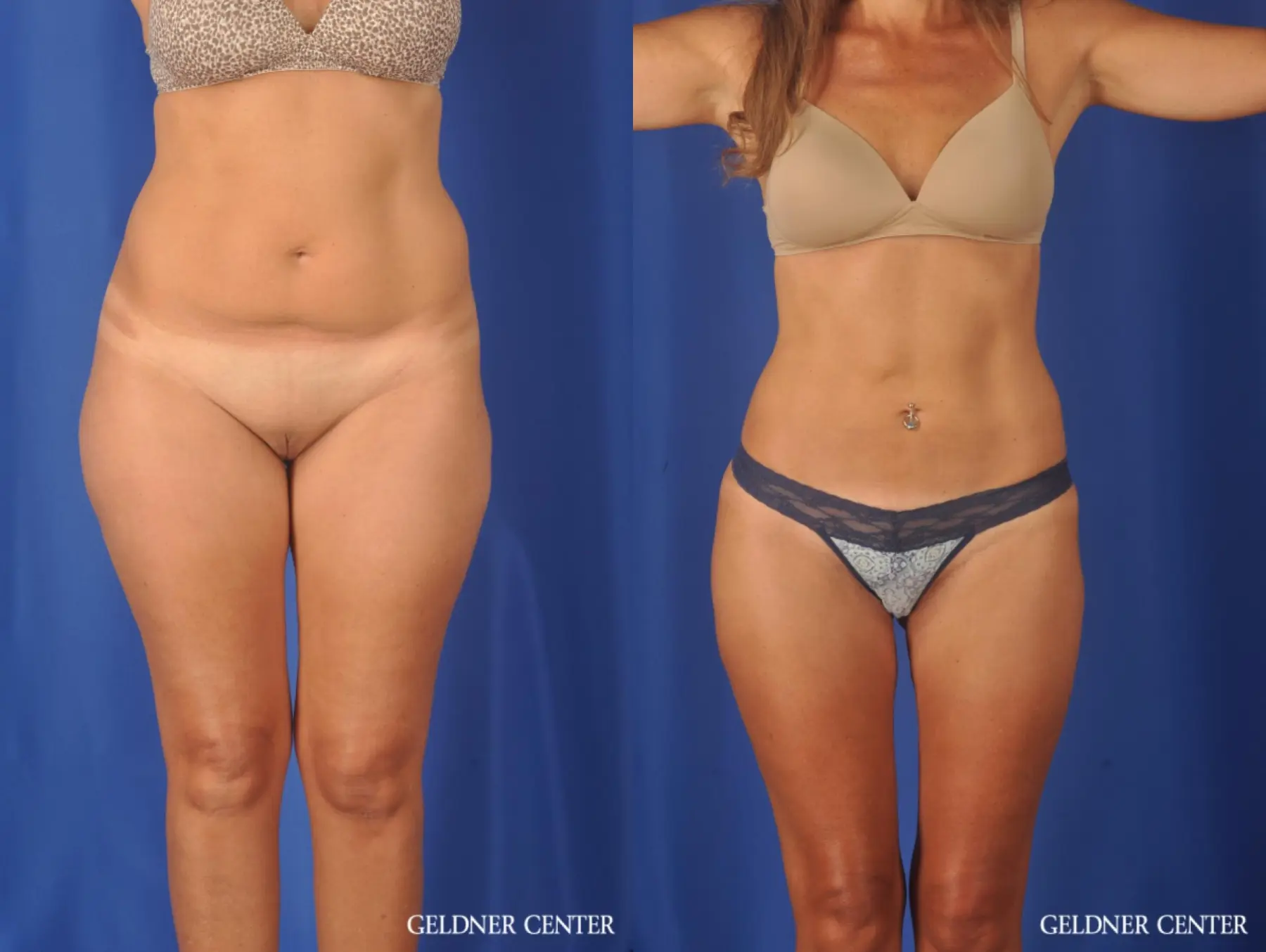 Liposuction: Patient 47 - Before and After 1