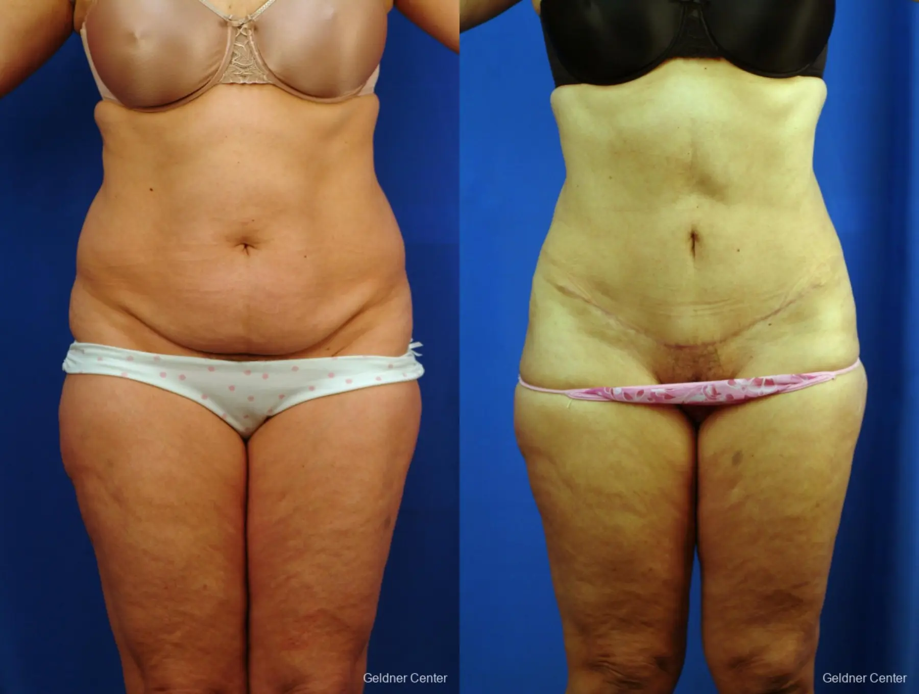 Liposuction: Patient 10 - Before and After  