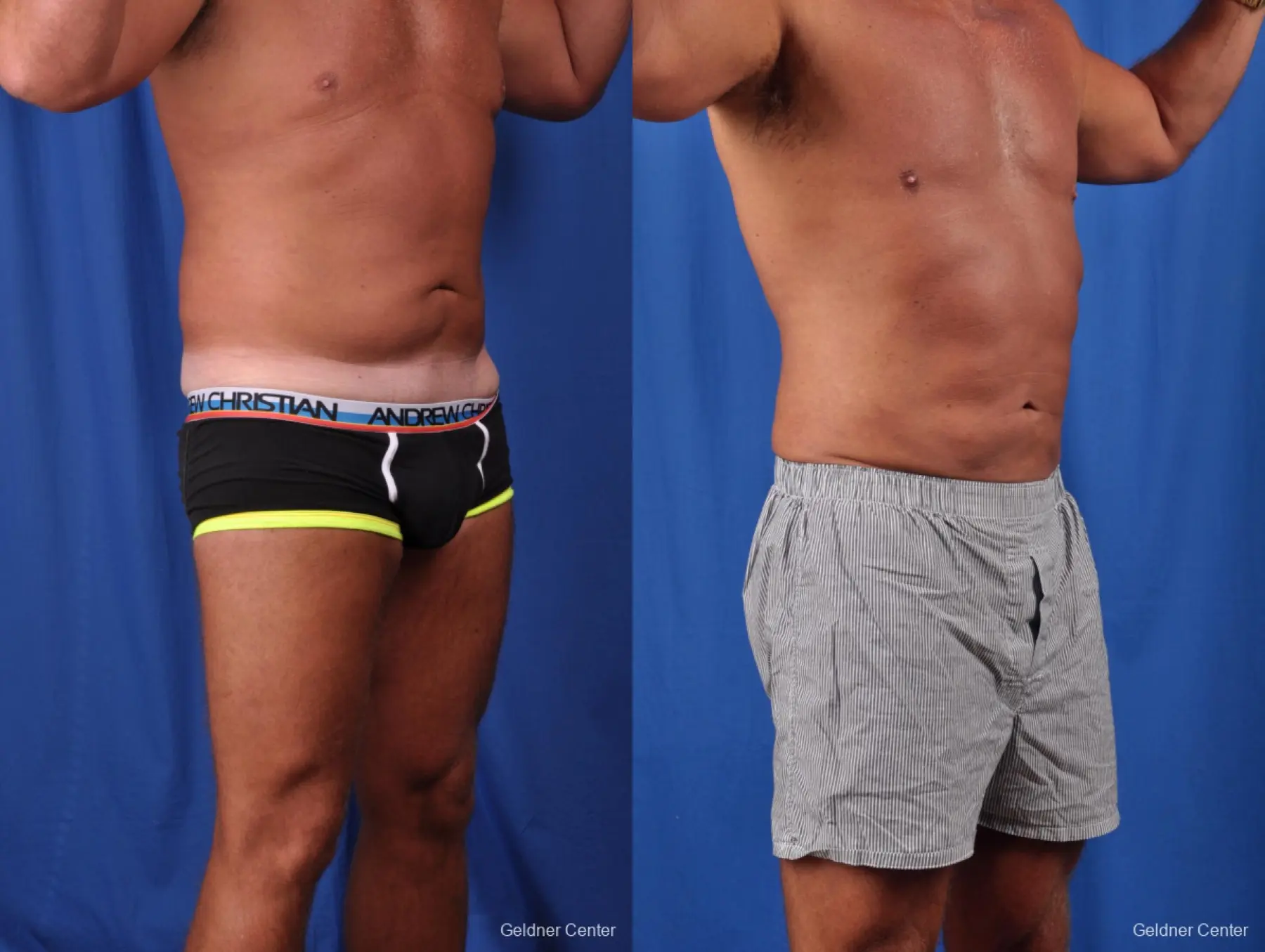 Liposuction For Men: Patient 5 - Before and After 2