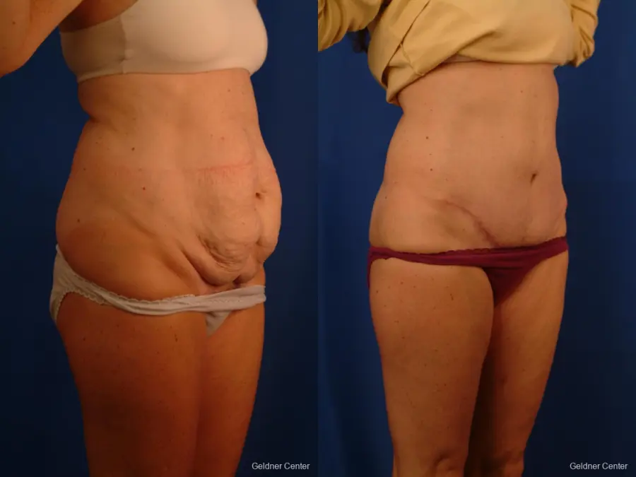 Liposuction: Patient 11 - Before and After 2