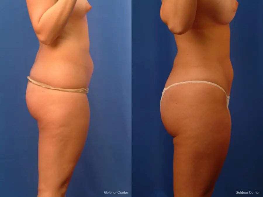 Liposuction: Patient 13 - Before and After 3