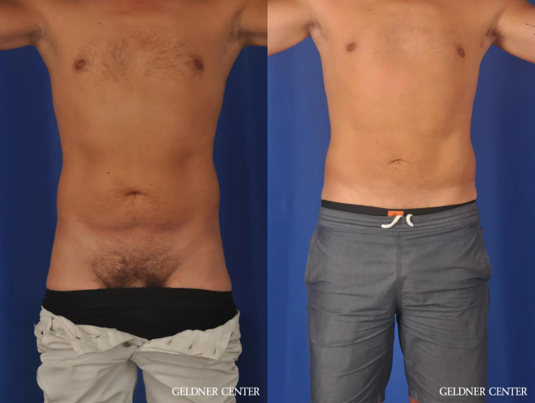 Liposuction For Men: Patient 12 - Before and After 1