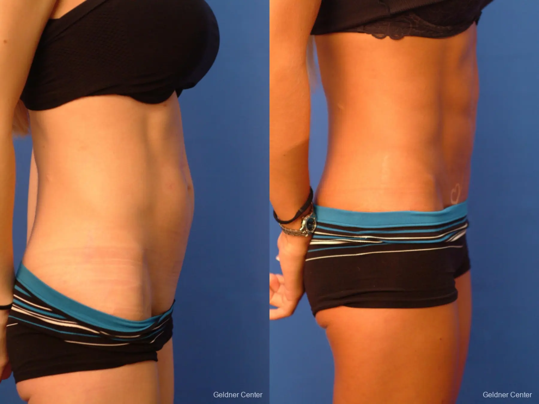 Vaser Liposuction with Abdominal Etching - Before and After 2