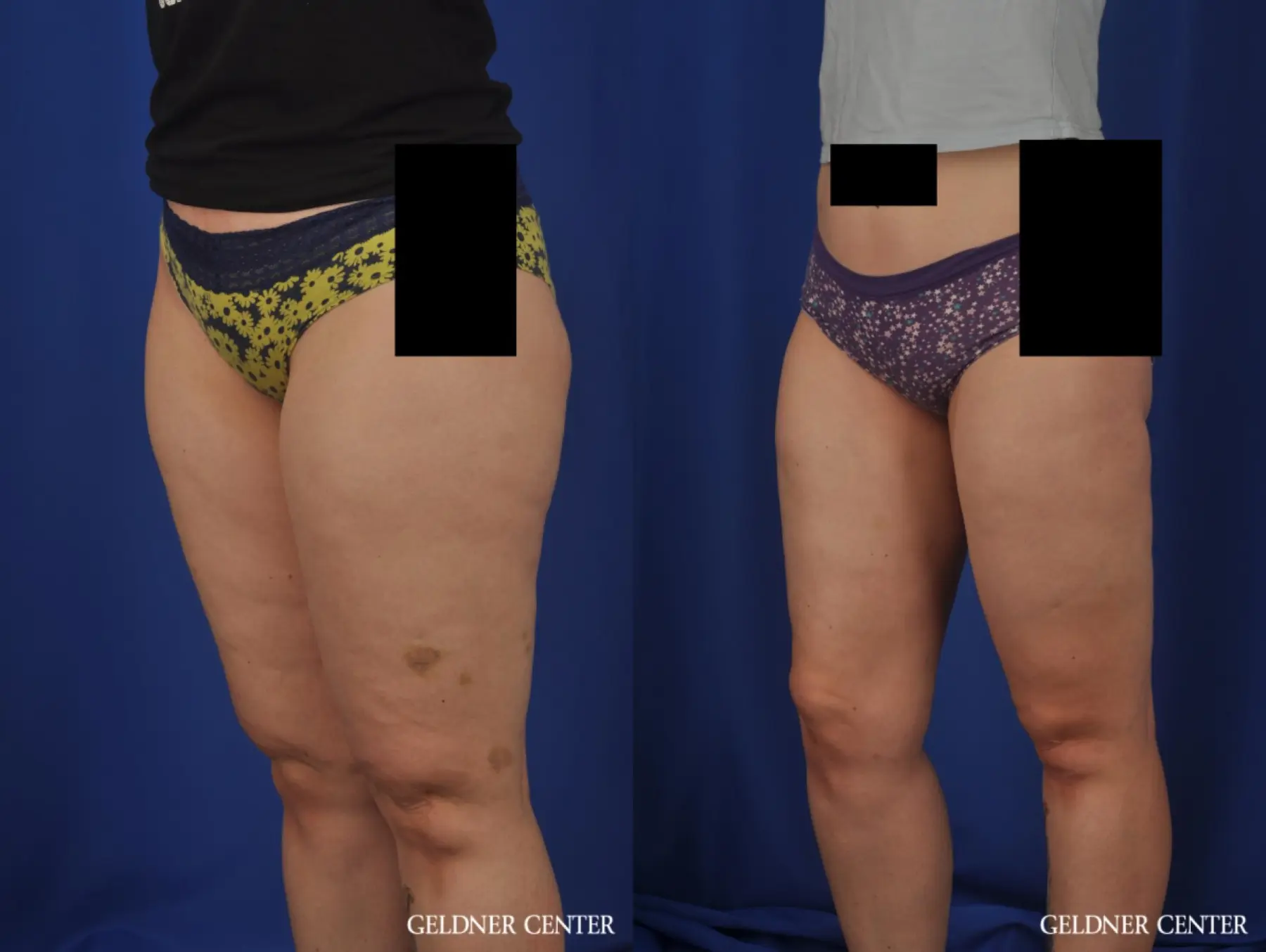 Liposuction: Patient 44 - Before and After 5