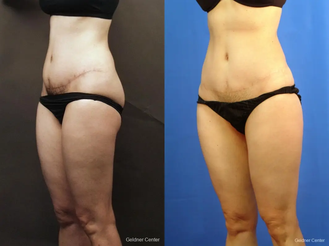 Liposuction: Patient 8 - Before and After 3