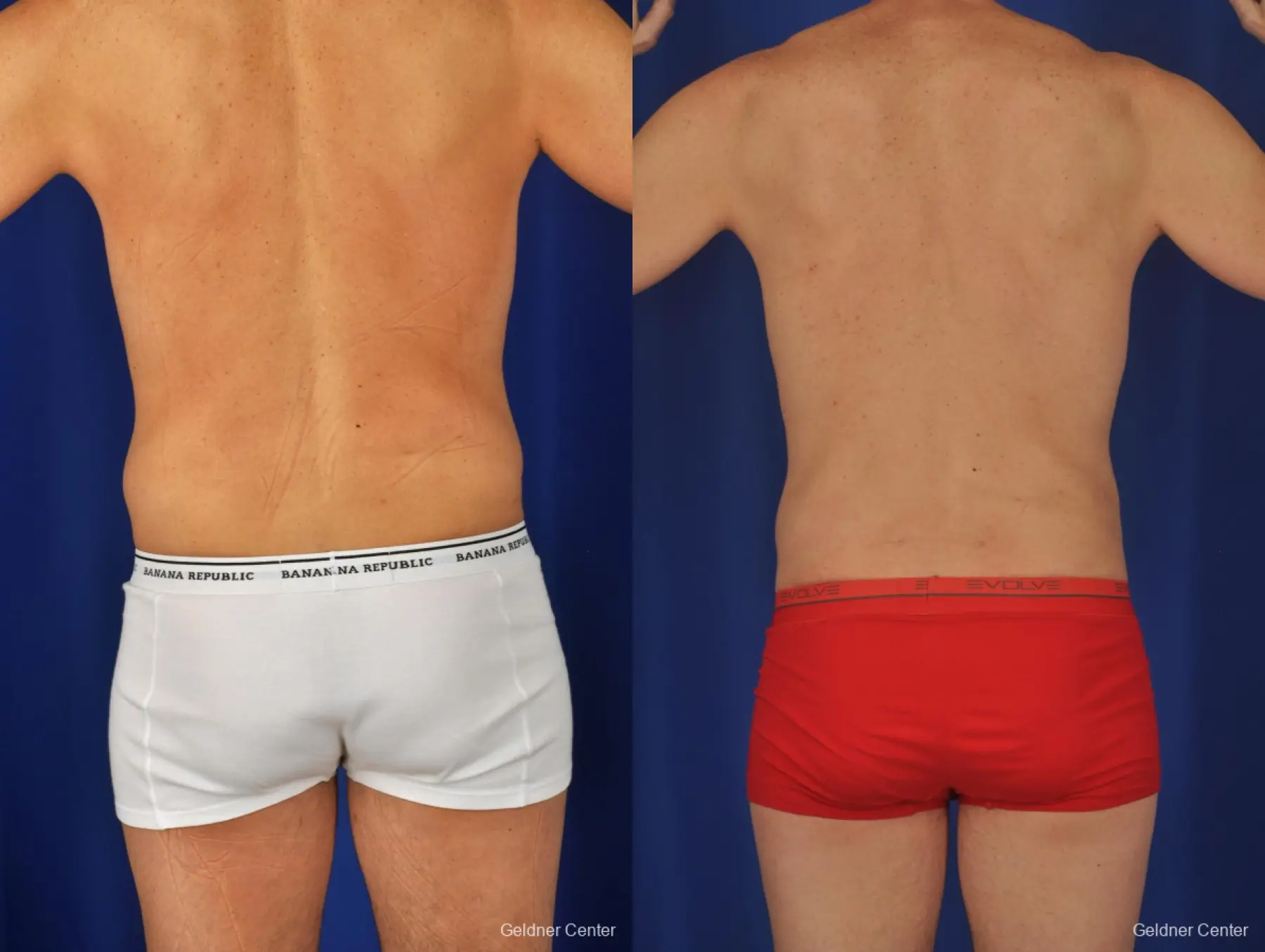 Liposuction For Men: Patient 2 - Before and After 4