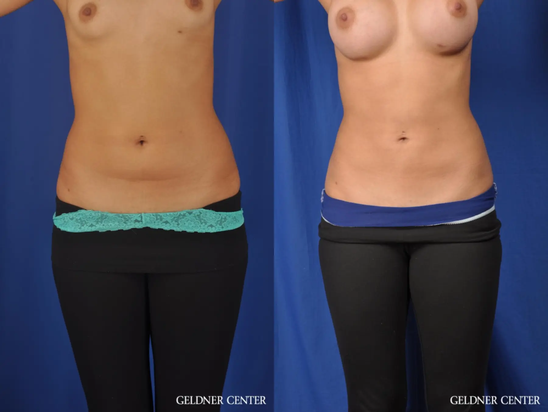 Liposuction: Patient 28 - Before and After 1