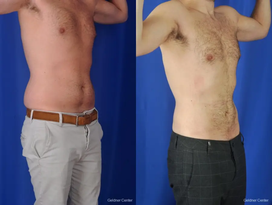 Liposuction For Men: Patient 3 - Before and After 2