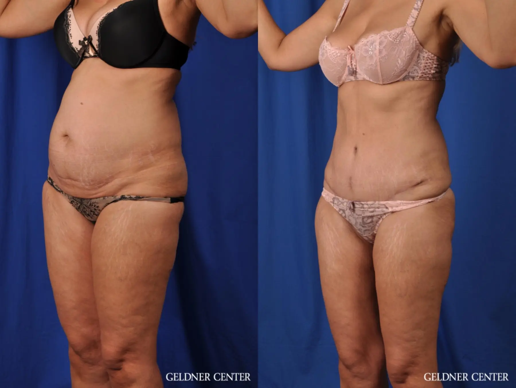 Liposuction: Patient 25 - Before and After 4