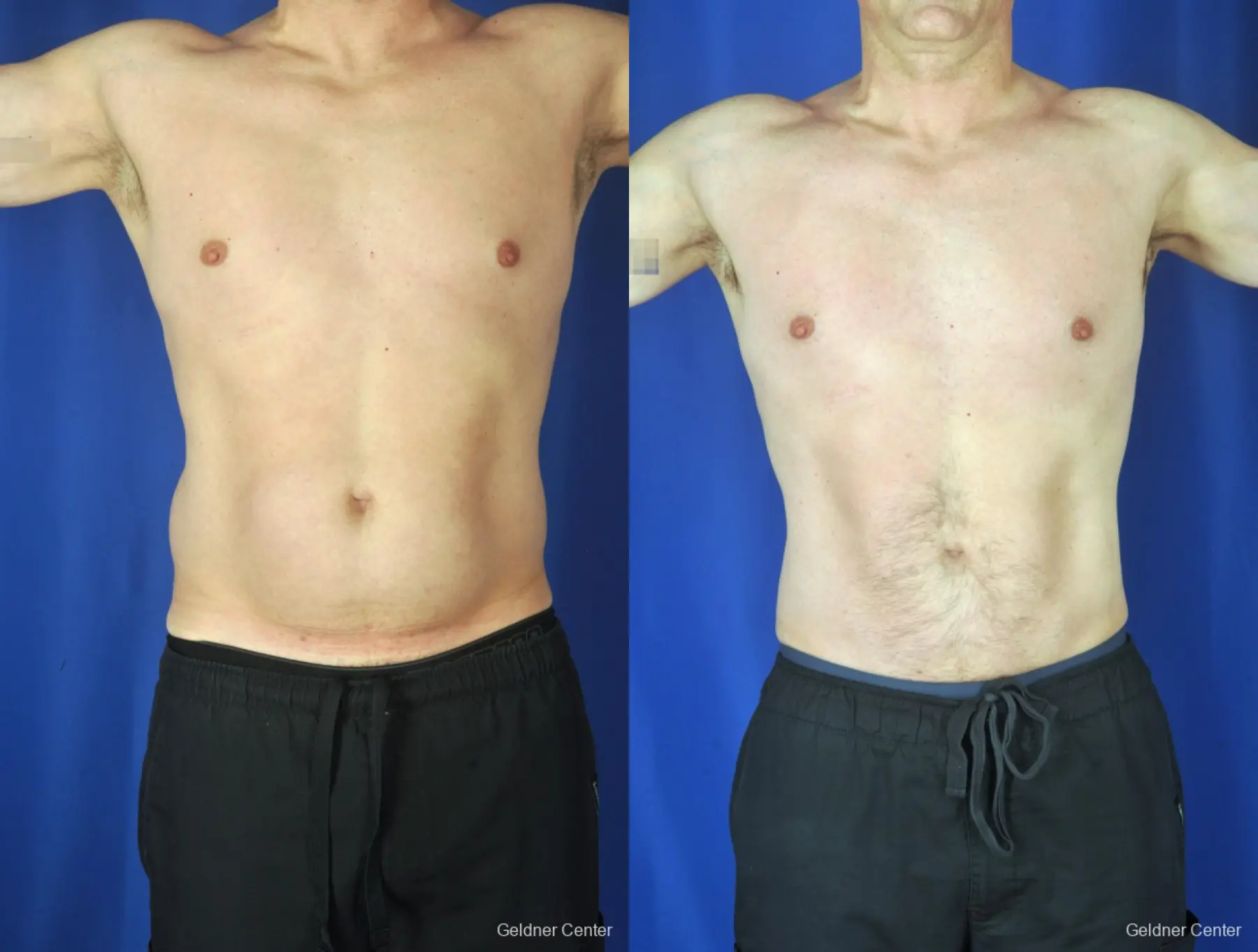 Liposuction For Men: Patient 9 - Before and After 1