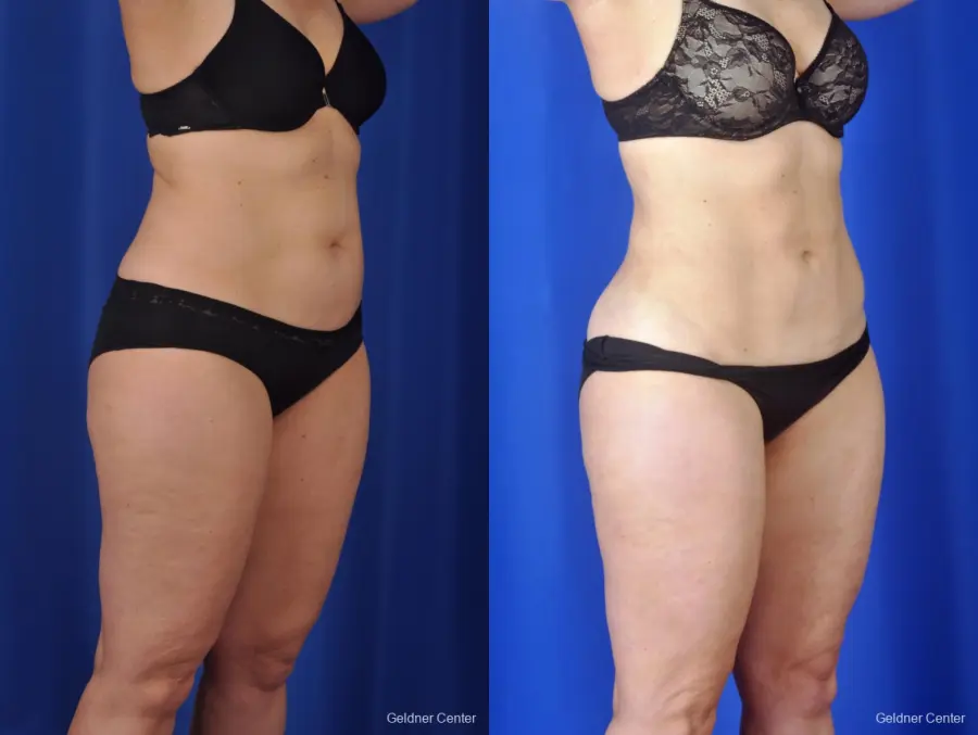 Liposuction: Patient 2 - Before and After 2