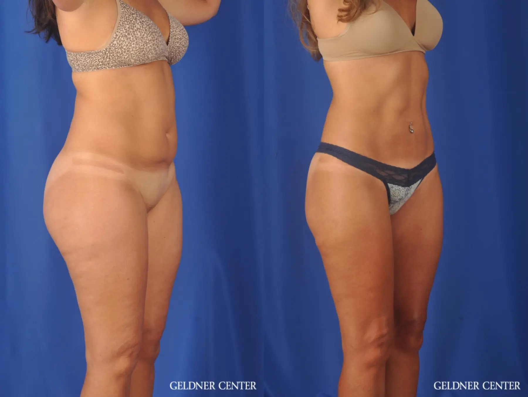 Liposuction: Patient 47 - Before and After 2