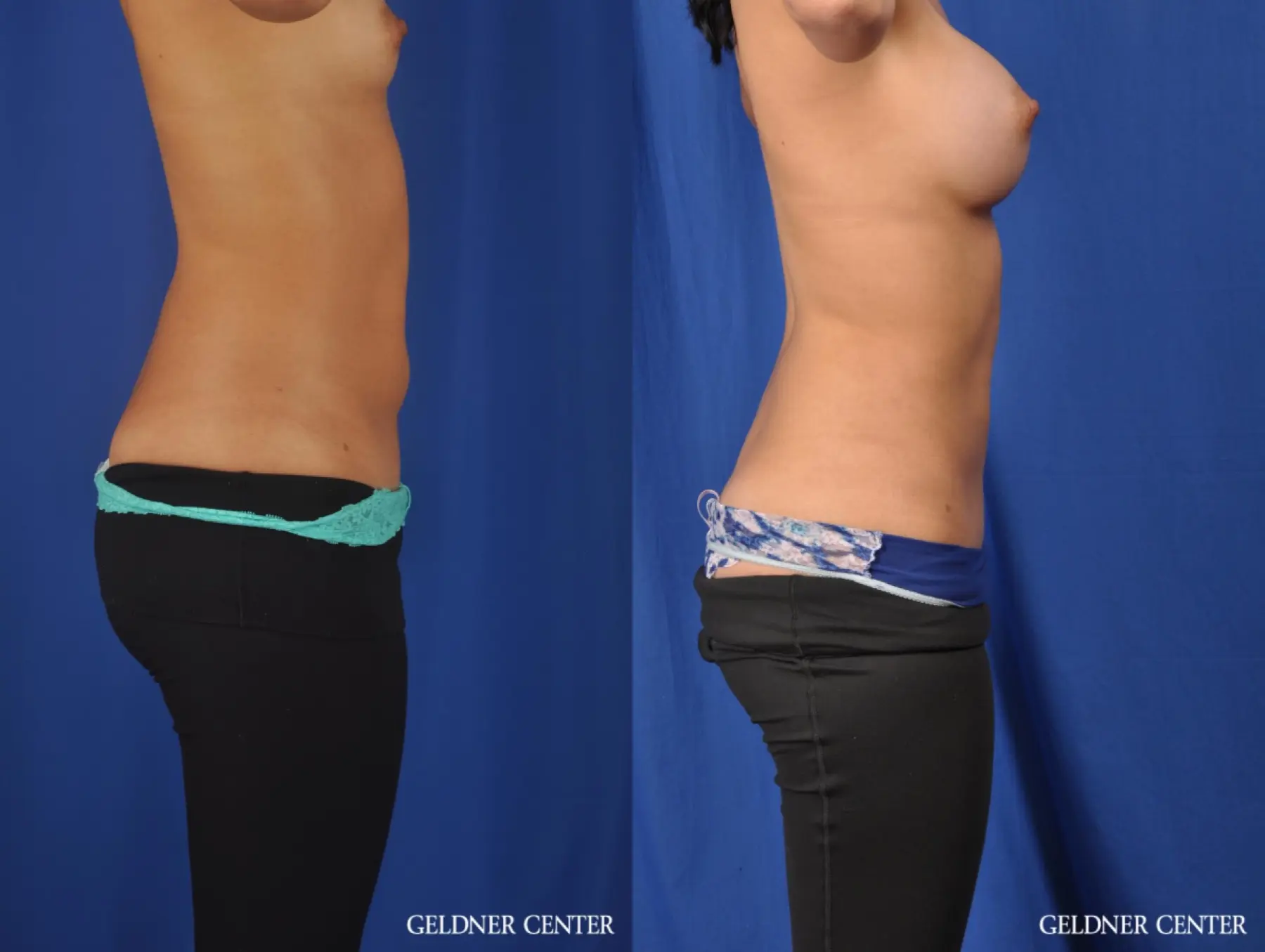 Liposuction: Patient 28 - Before and After 2