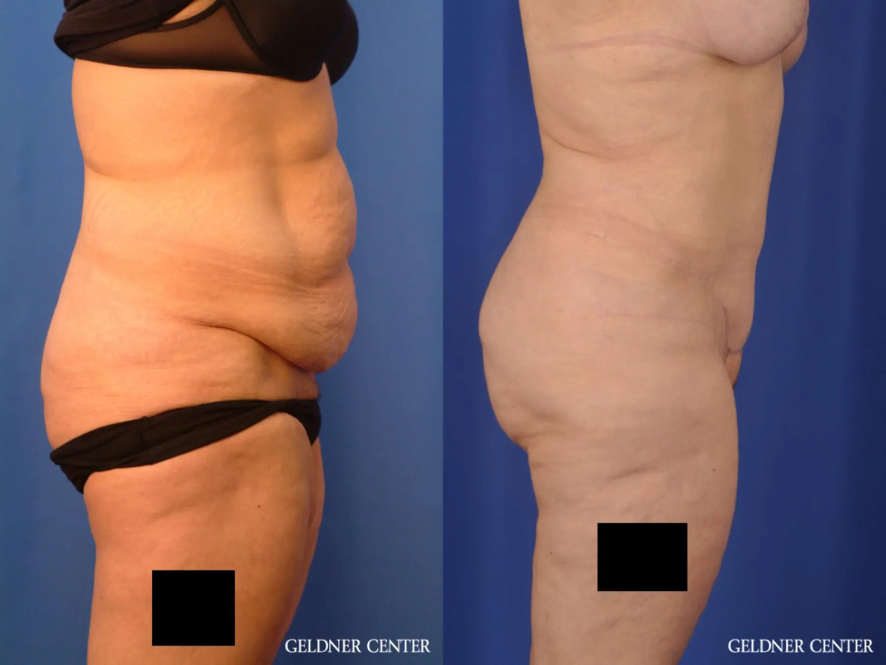 Liposuction: Patient 23 - Before and After 3