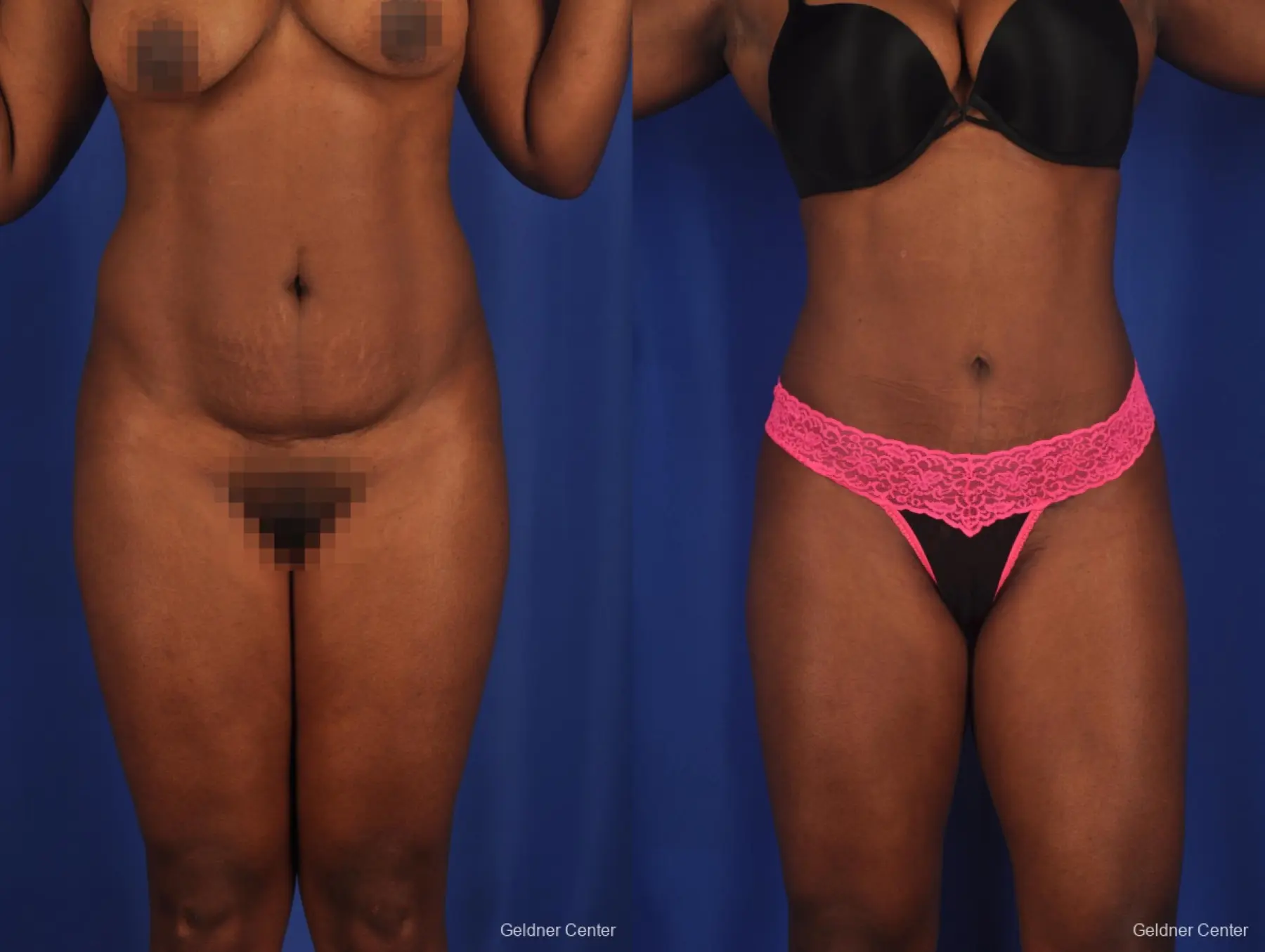 Liposuction: Patient 3 - Before and After 1