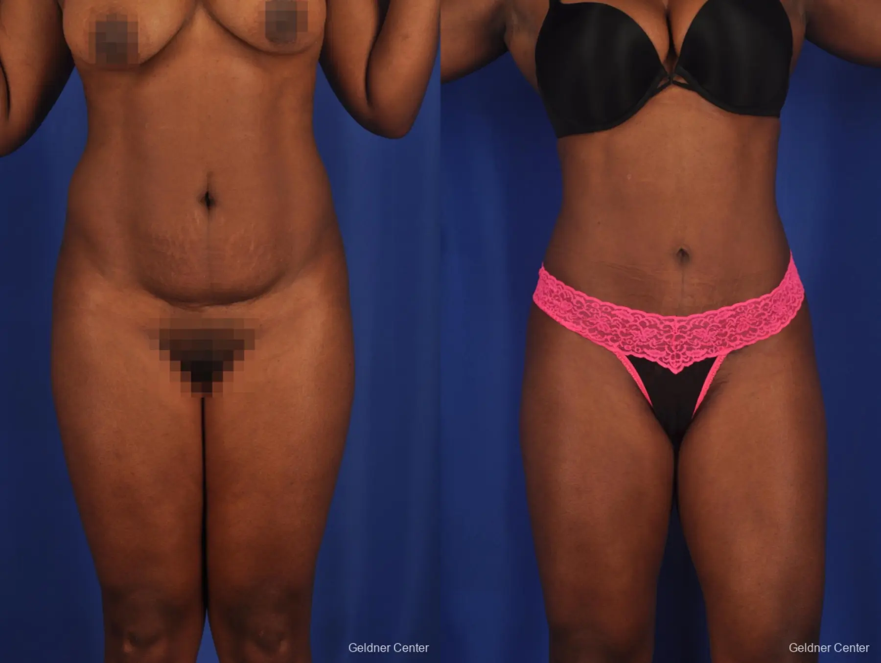 Liposuction: Patient 3 - Before and After  