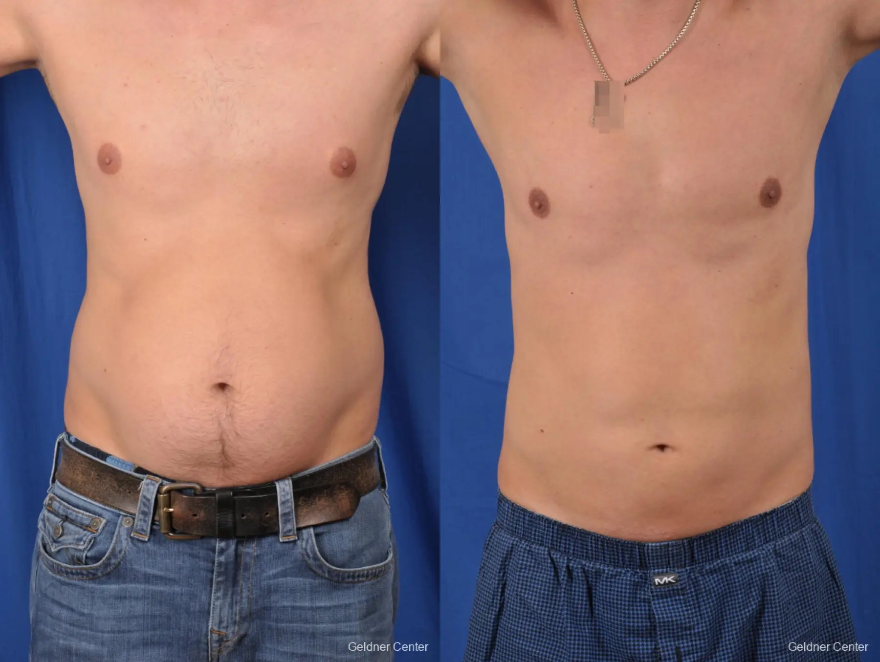 Liposuction For Men: Patient 6 - Before and After 1