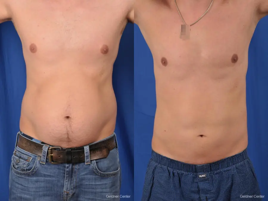 Liposuction-for-men: Patient 6 - Before and After  