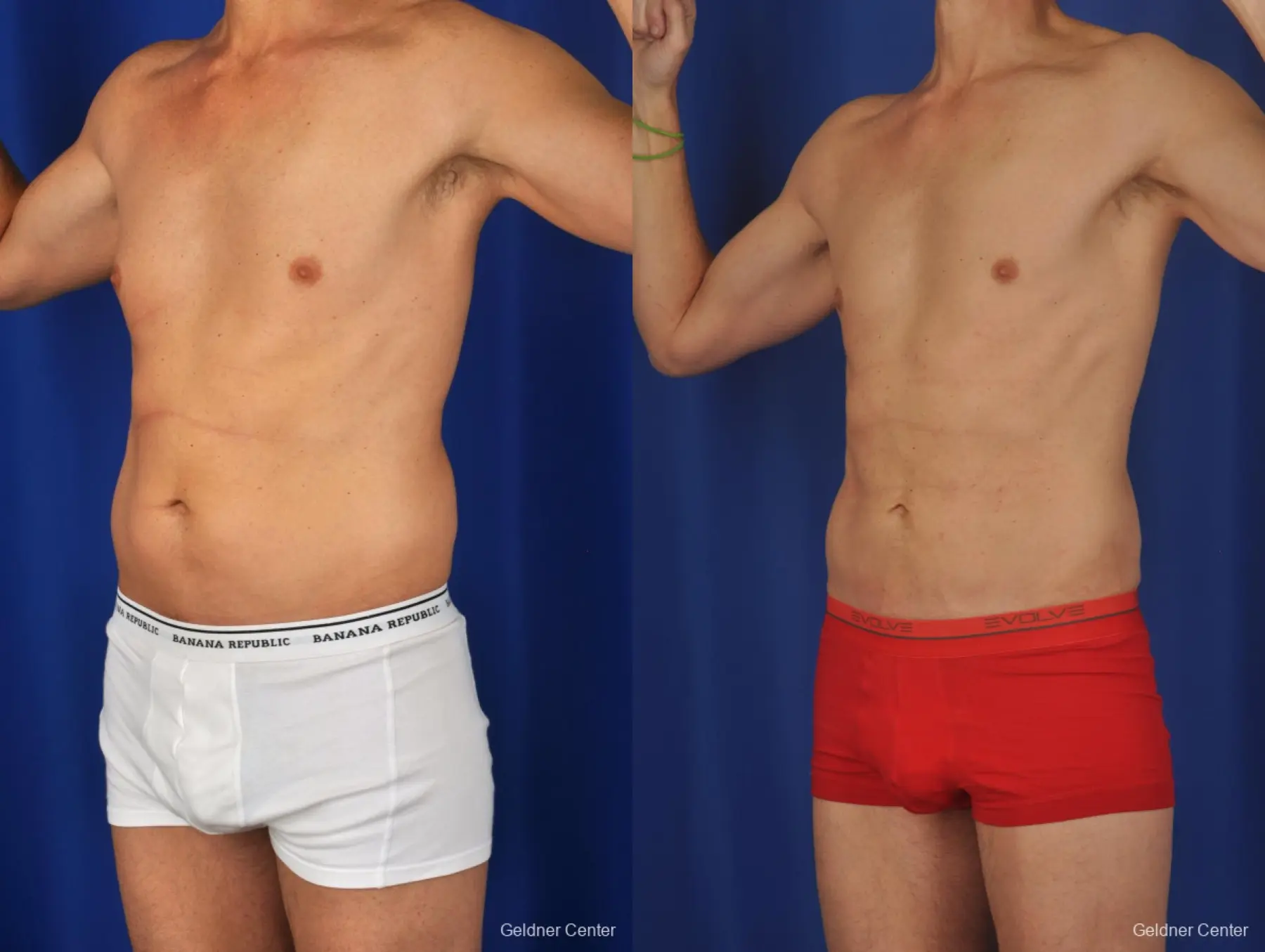 Liposuction For Men: Patient 2 - Before and After 5