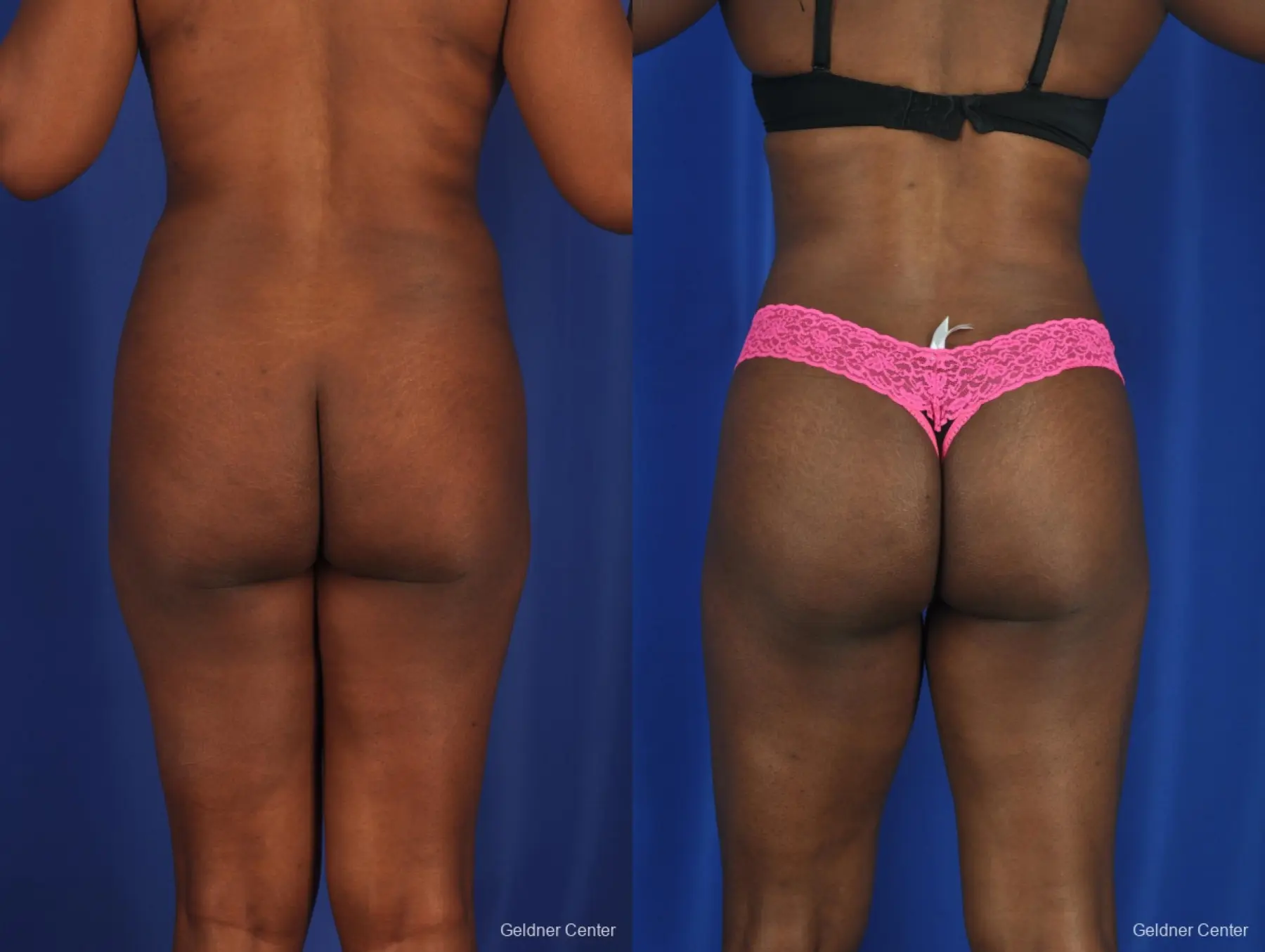Liposuction: Patient 3 - Before and After 4