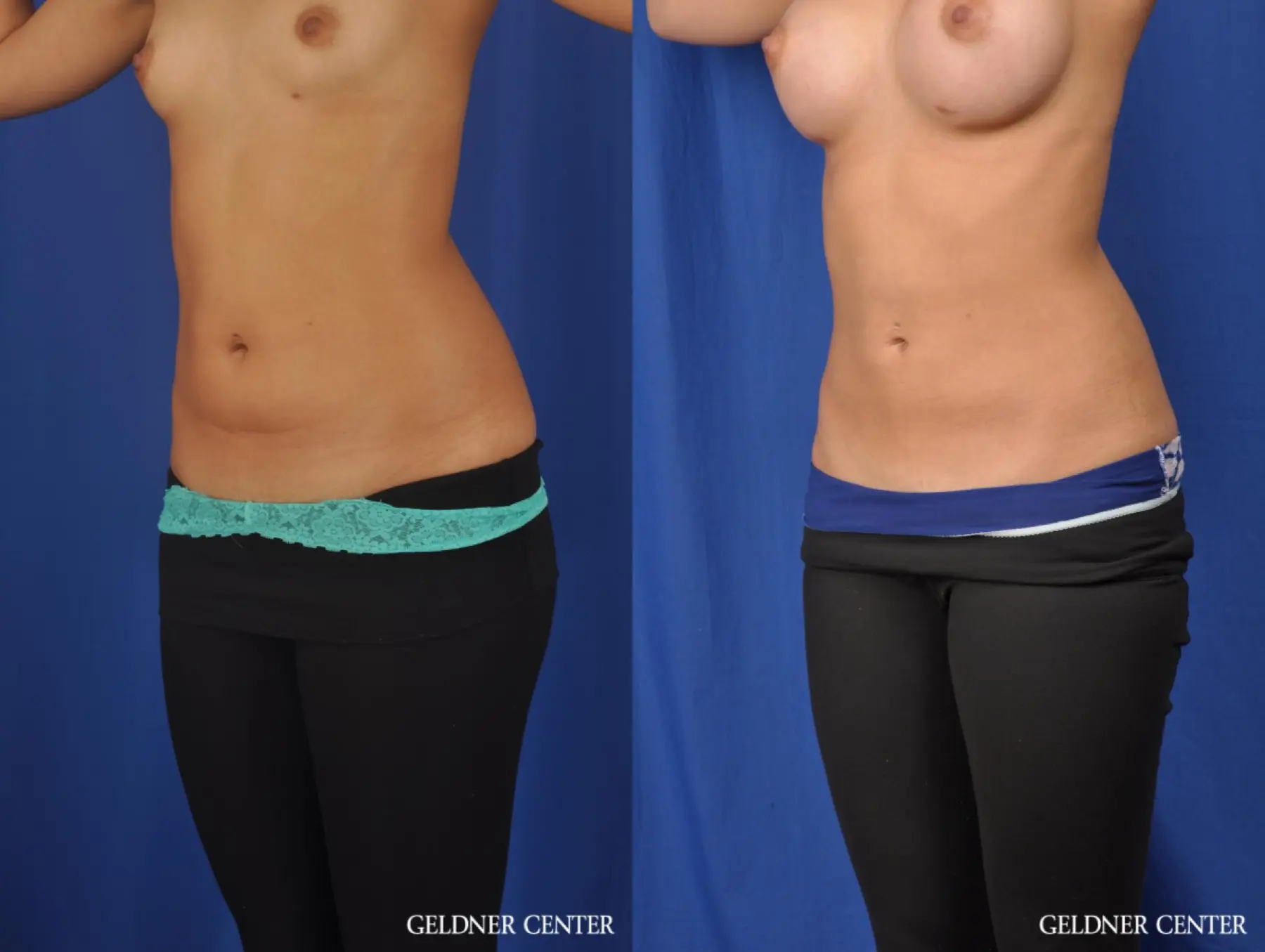 Liposuction: Patient 28 - Before and After 4