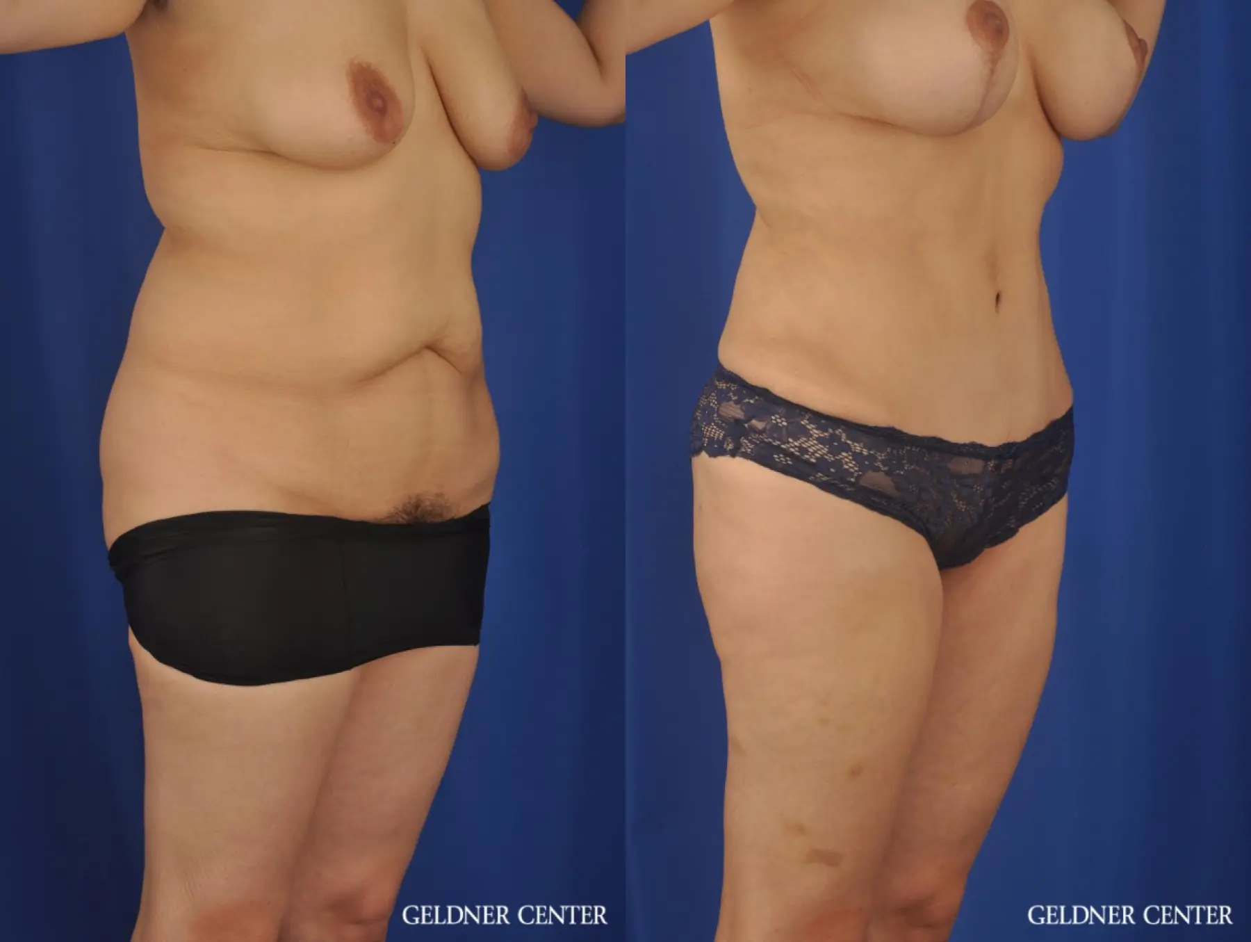 Liposuction: Patient 31 - Before and After 2
