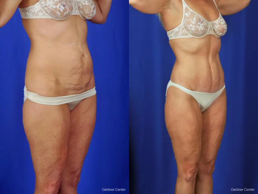 Liposuction: Patient 4 - Before and After 2