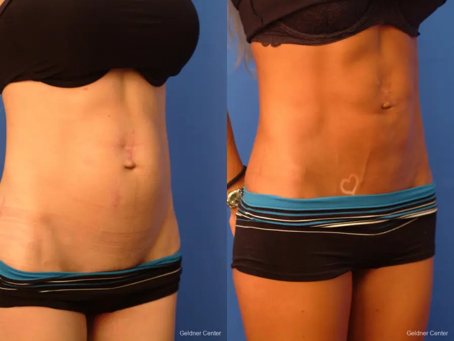  Vaser Liposuction with Abdominal Etching - Before and After 3