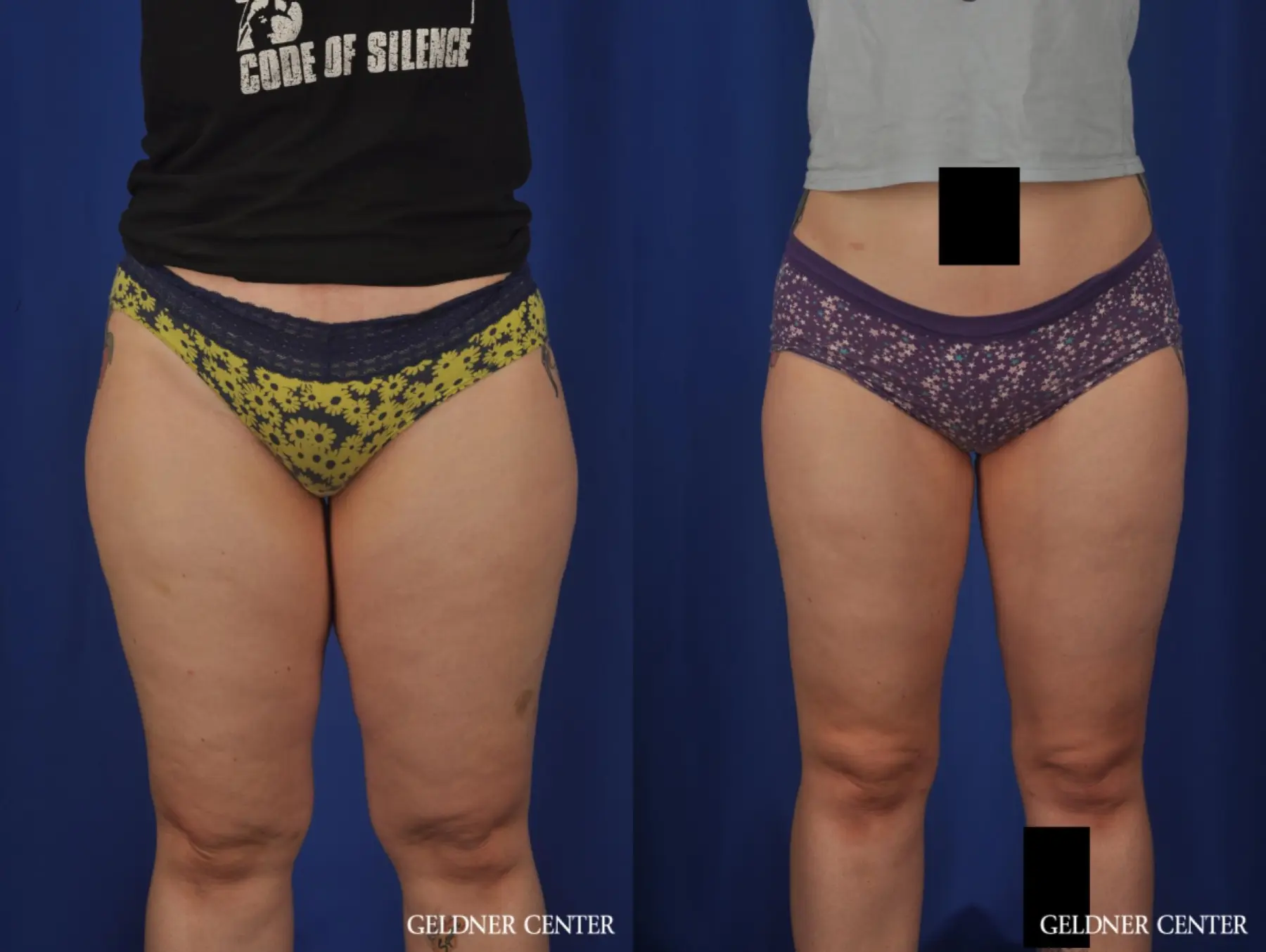 Liposuction: Patient 44 - Before and After  