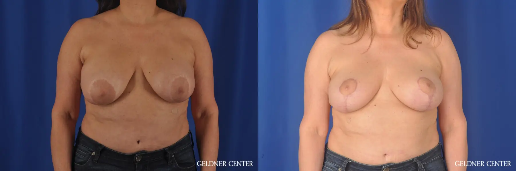 Liposuction: Patient 35 - Before and After  