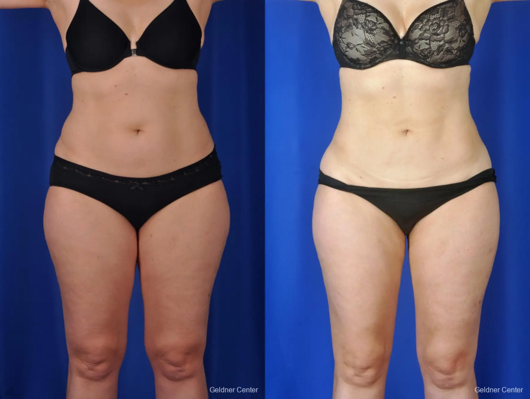 Liposculpture and Liposuction Before and After