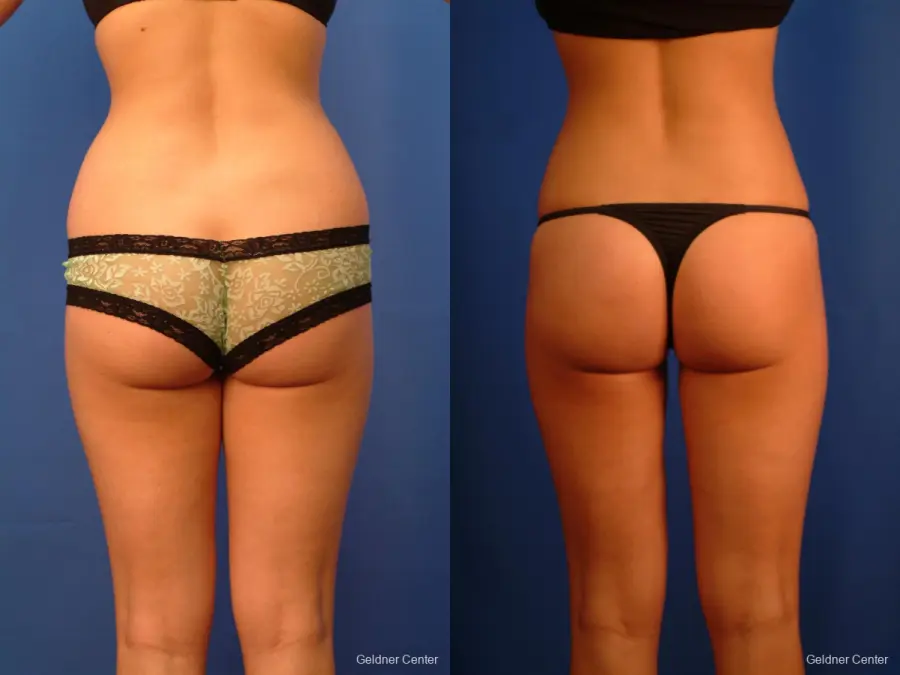 Liposuction: Patient 14 - Before and After 5