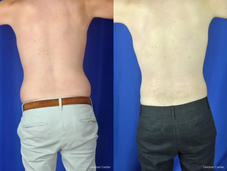 Liposuction For Men: Patient 3 - Before and After 4