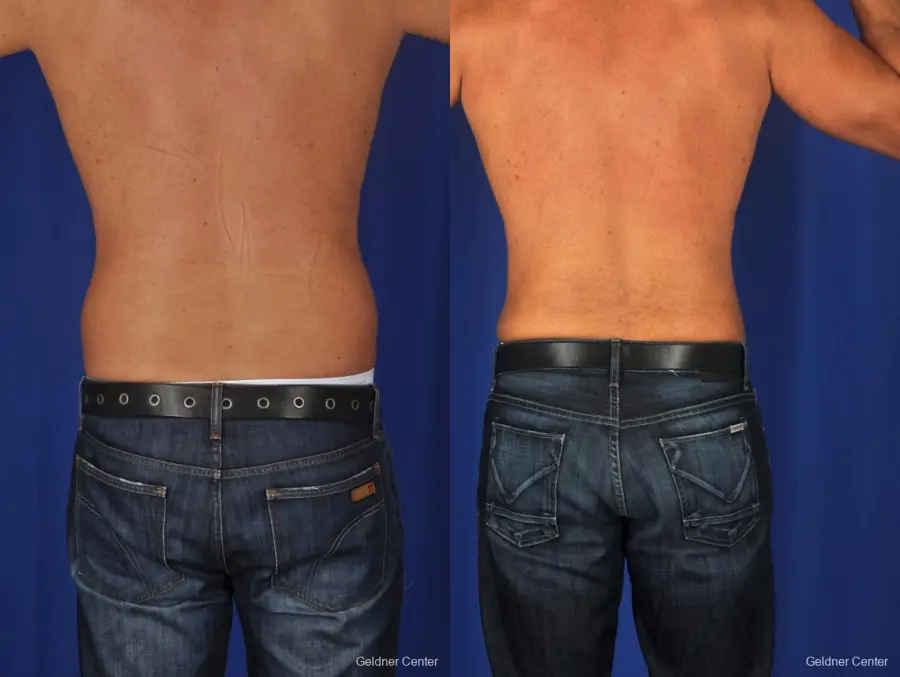 Liposuction For Men: Patient 1 - Before and After 4