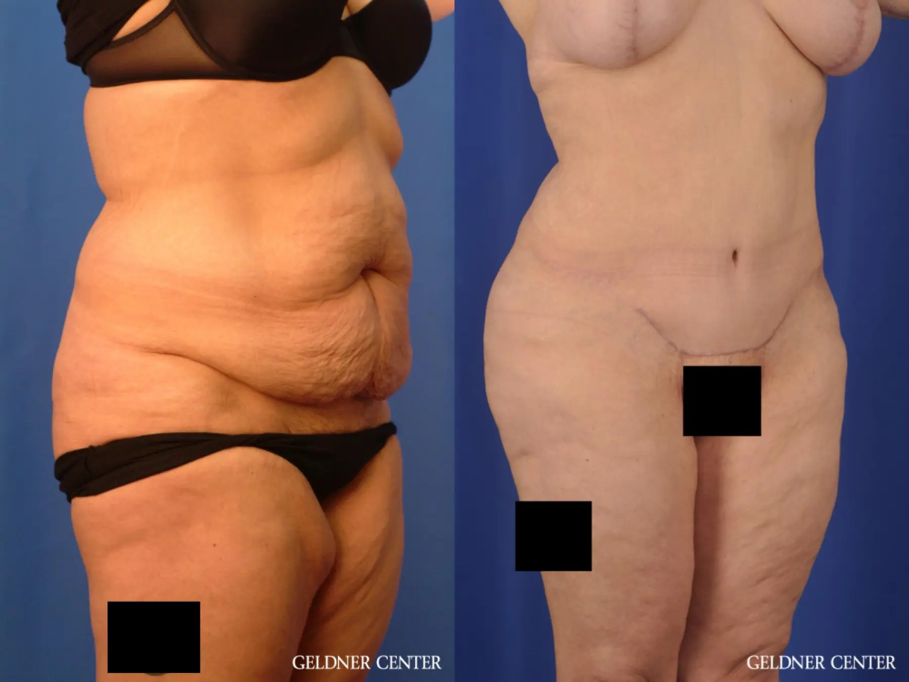 Liposuction: Patient 23 - Before and After 2