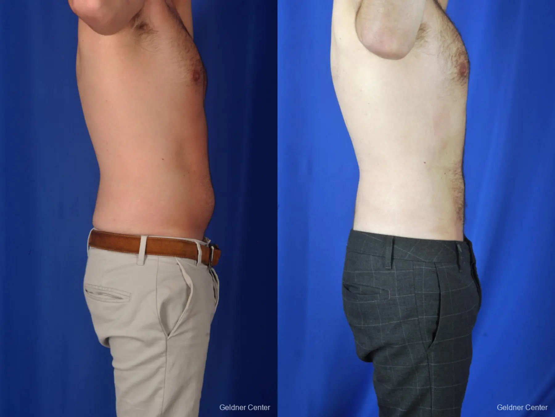 Liposuction For Men: Patient 3 - Before and After 3