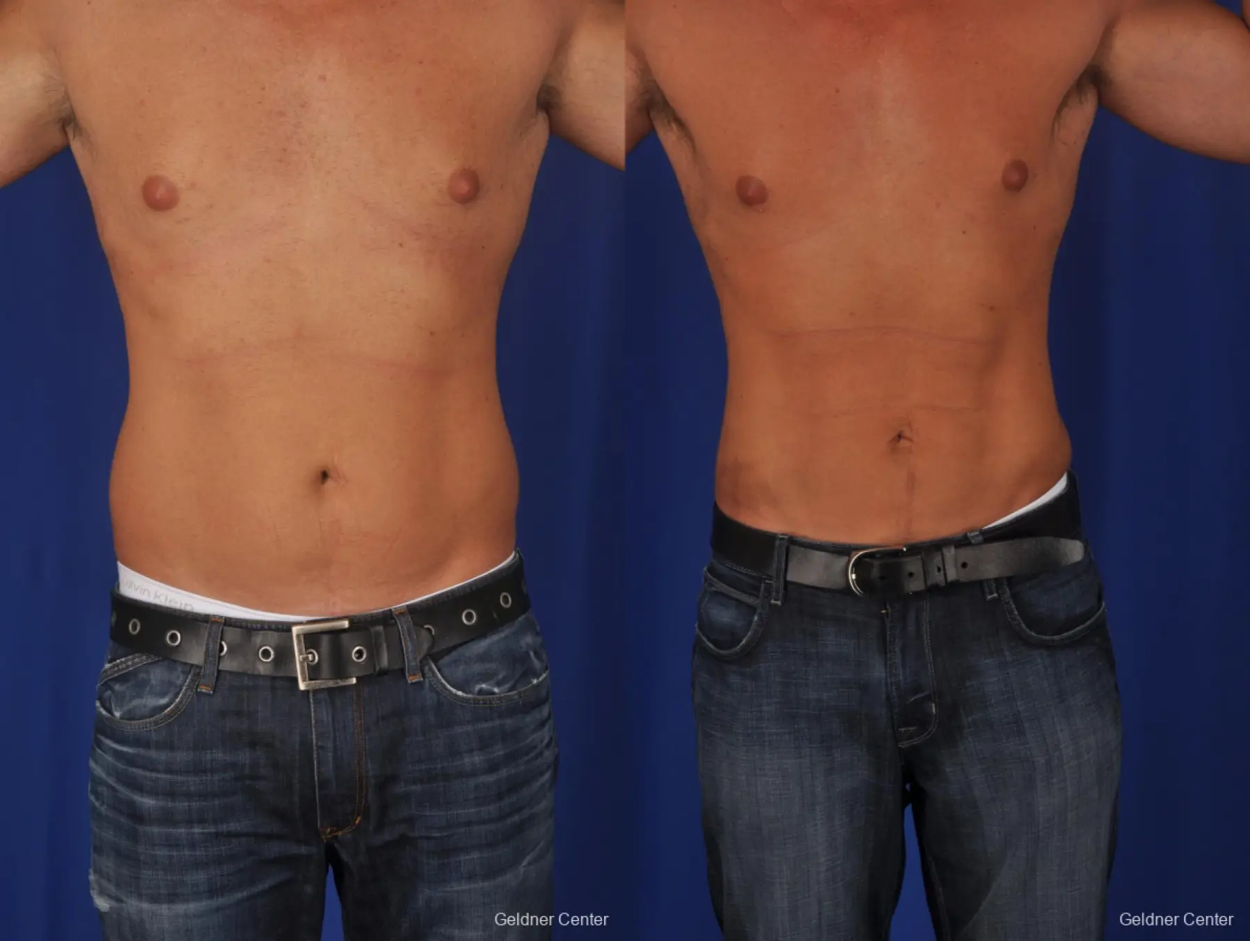 Liposuction-for-men: Patient 1 - Before and After  