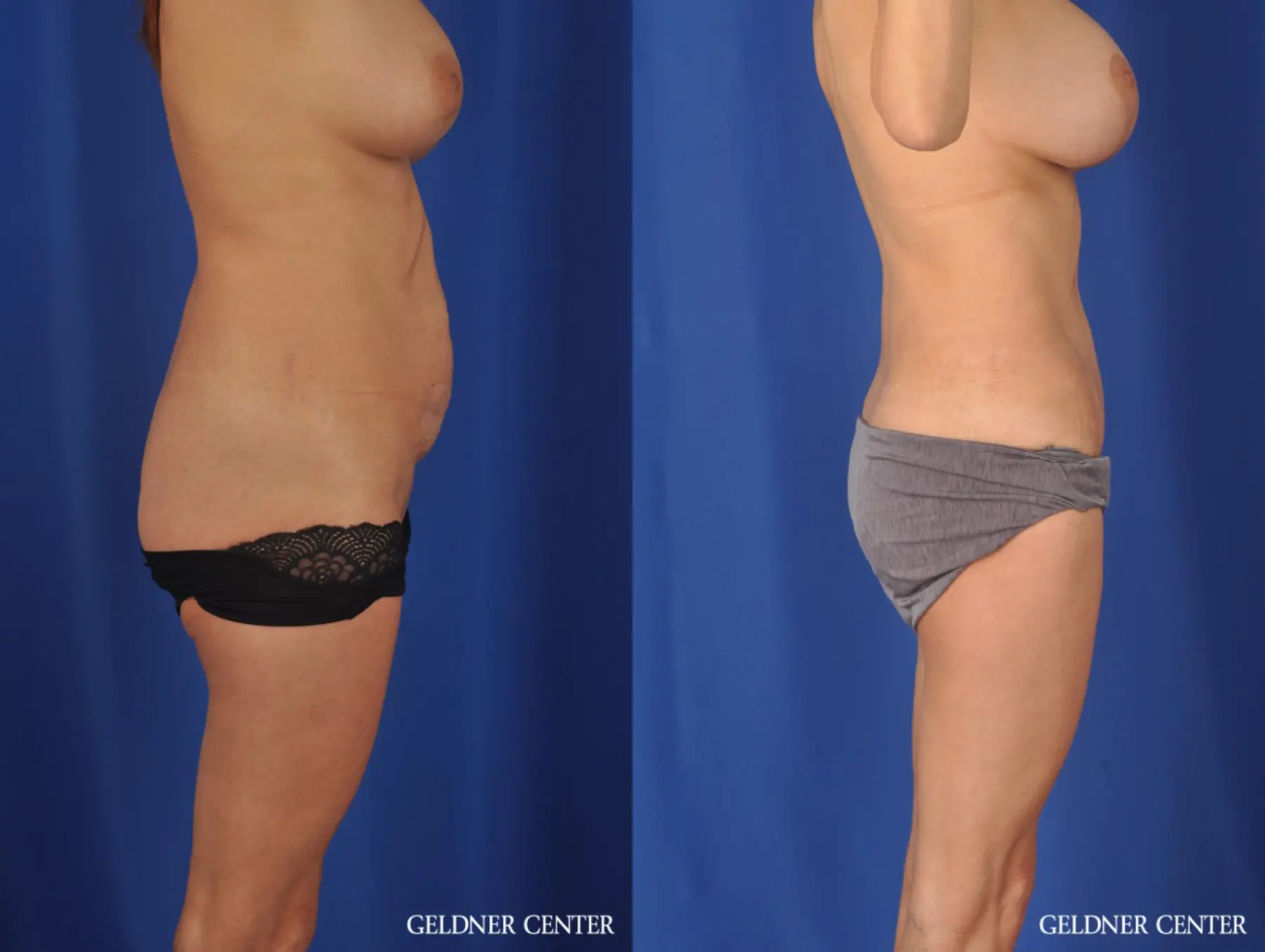 Liposuction: Patient 37 - Before and After 3