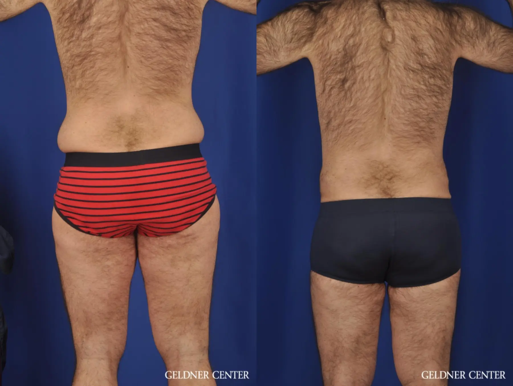 Liposuction For Men: Patient 10 - Before and After 4