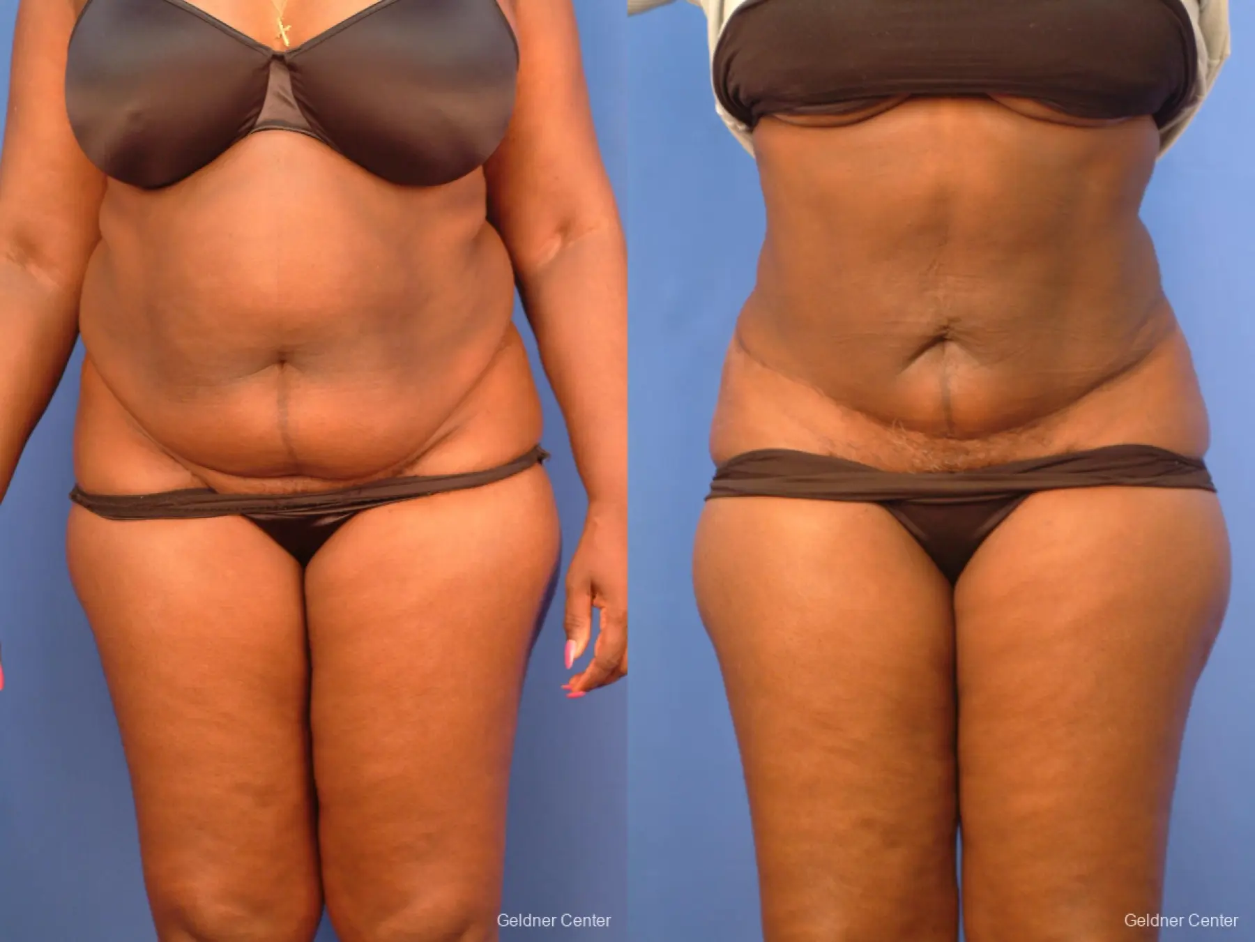 Liposuction: Patient 19 - Before and After 1