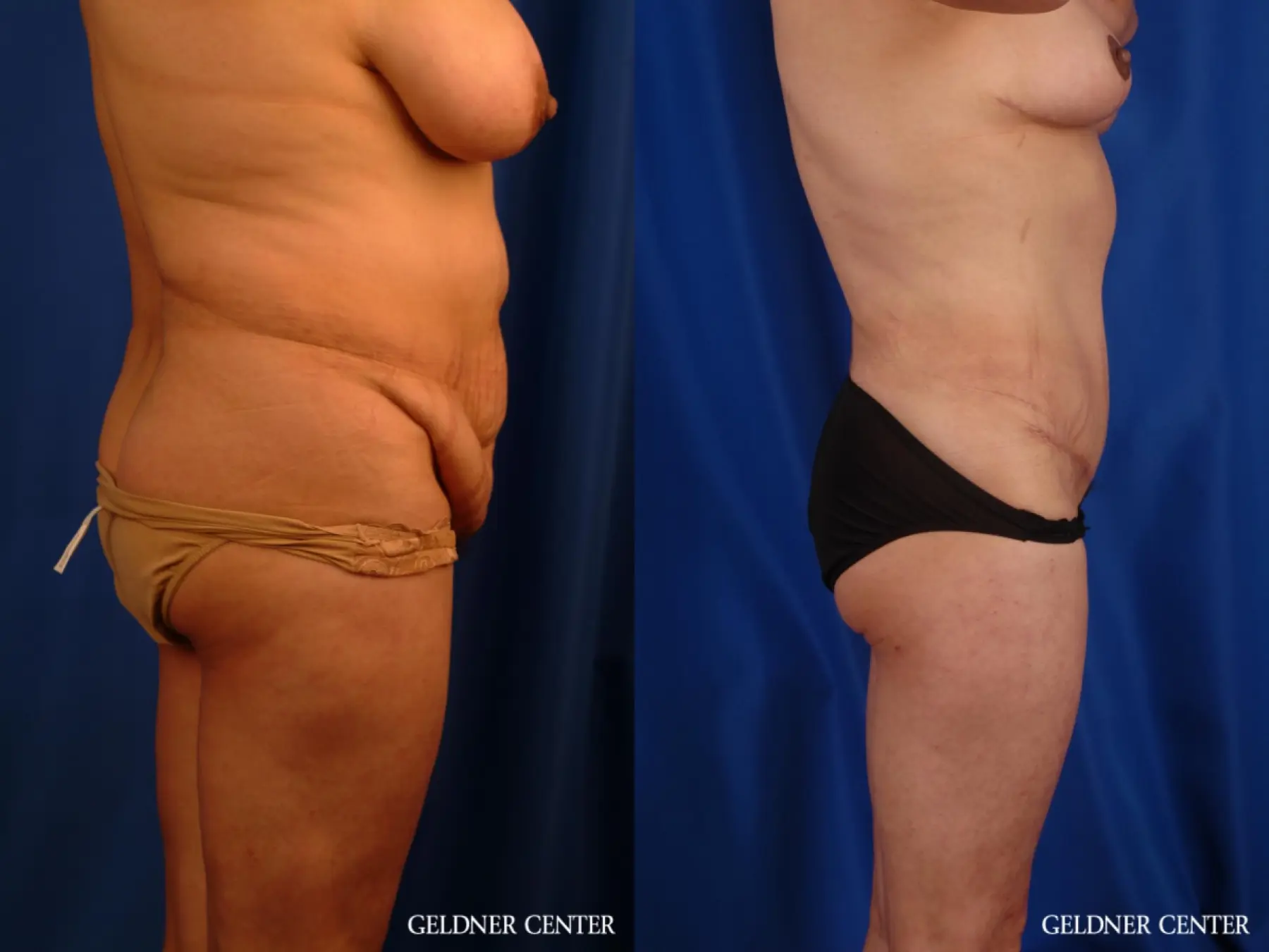 Liposuction: Patient 21 - Before and After 3