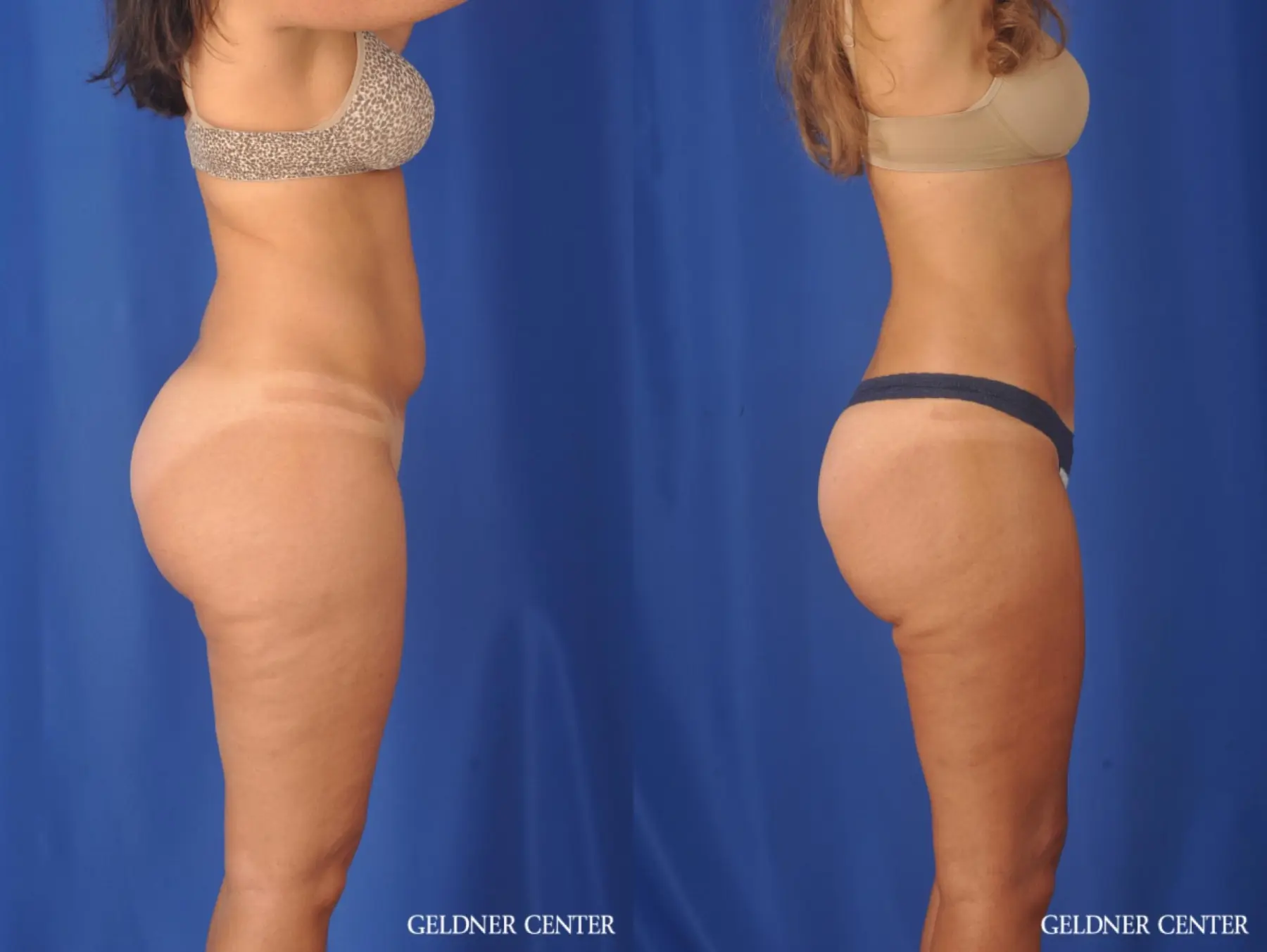 Liposuction: Patient 47 - Before and After 3