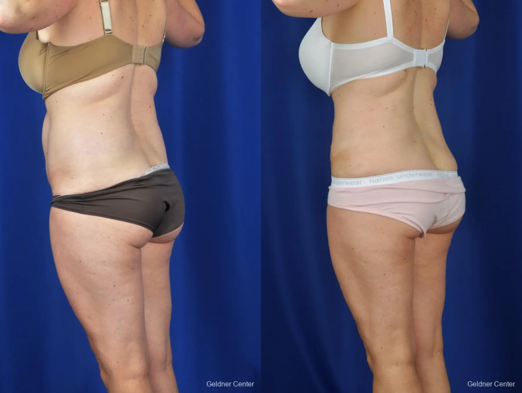 Liposuction: Patient 6 - Before and After 5