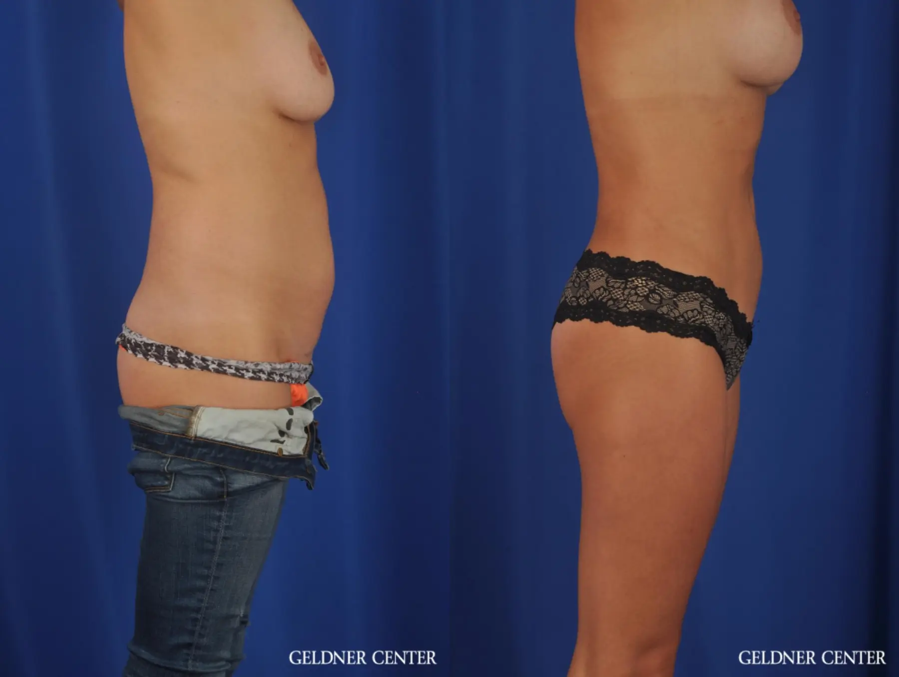 Liposuction: Patient 29 - Before and After 3