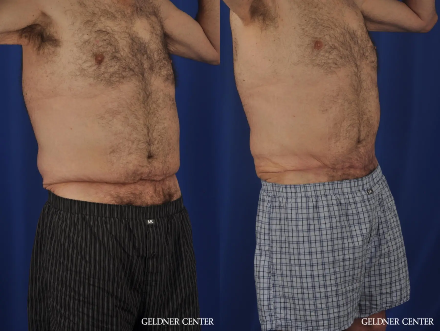 Liposuction For Men: Patient 11 - Before and After 2