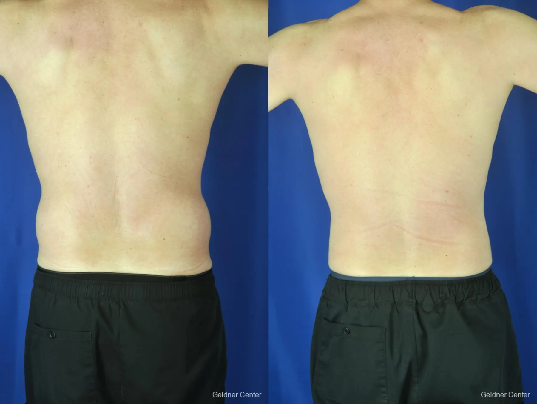 Liposuction For Men: Patient 9 - Before and After 4